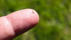 How to get rid of a splinter without needles or pain